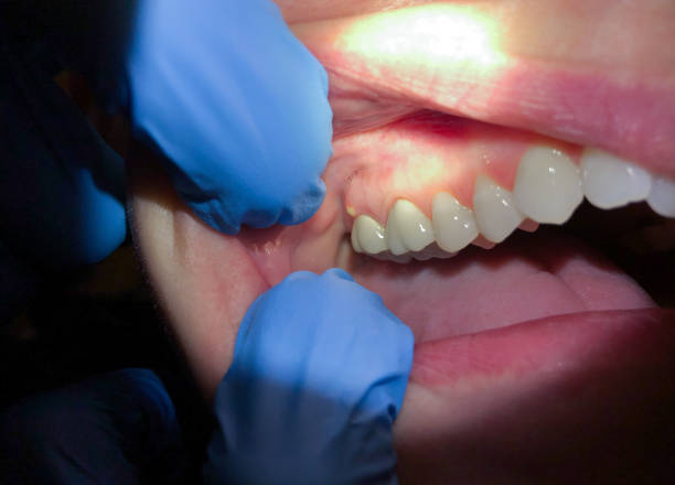 Best Emergency Denture Repair in Muscatine, IA